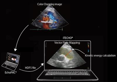 Blood flow kinetic energy is a novel marker for right ventricular global systolic function in patients with left ventricular assist device therapy